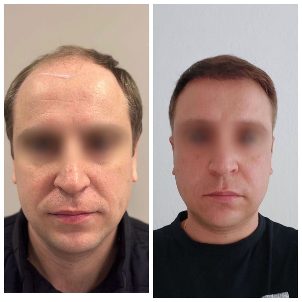 Résultats avant et après greffe de cheveux DHI à Adem and Havva Medical Center, ligne capillaire plus dense