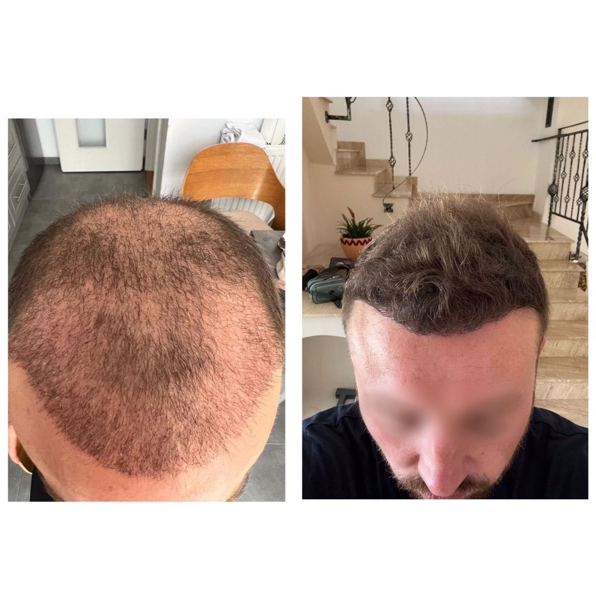 Résultats avant et après greffe de cheveux DHI à Adem and Havva Medical Center, ligne améliorée