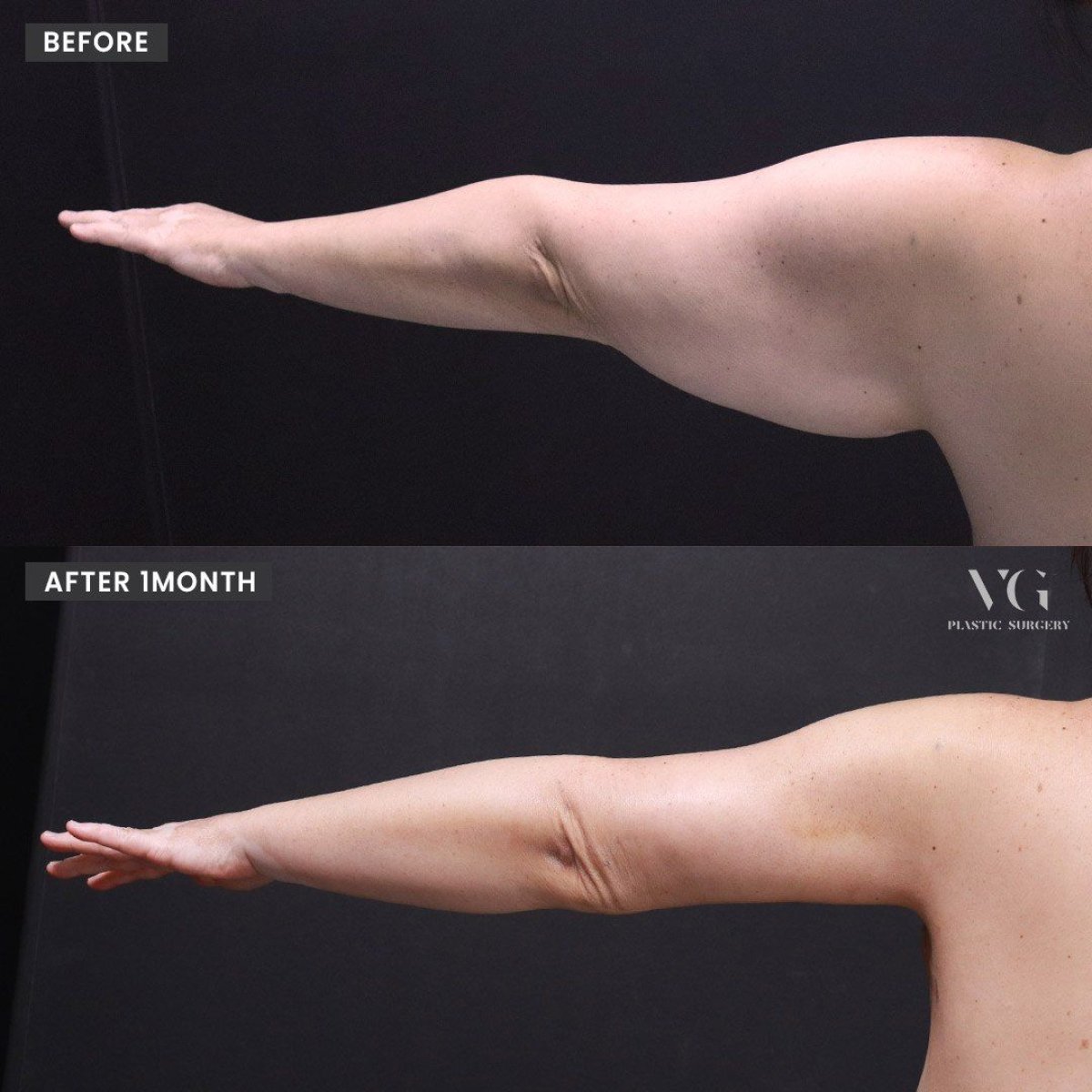 نتائج قبل وبعد شفط الدهون بالفيزر للذراعين في VG Plastic Surgery، مظهر أنحف