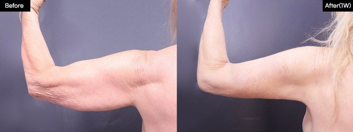 نتائج قبل وبعد شفط الدهون بالفيزر للذراع في VG Plastic Surgery، تحسين شكل الذراع