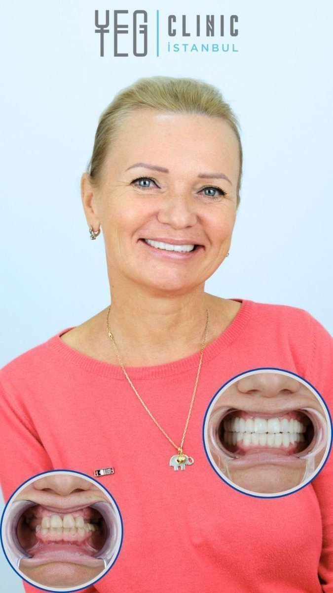 Before and after denture results at YEG Clinic – improved smile and dental restoration