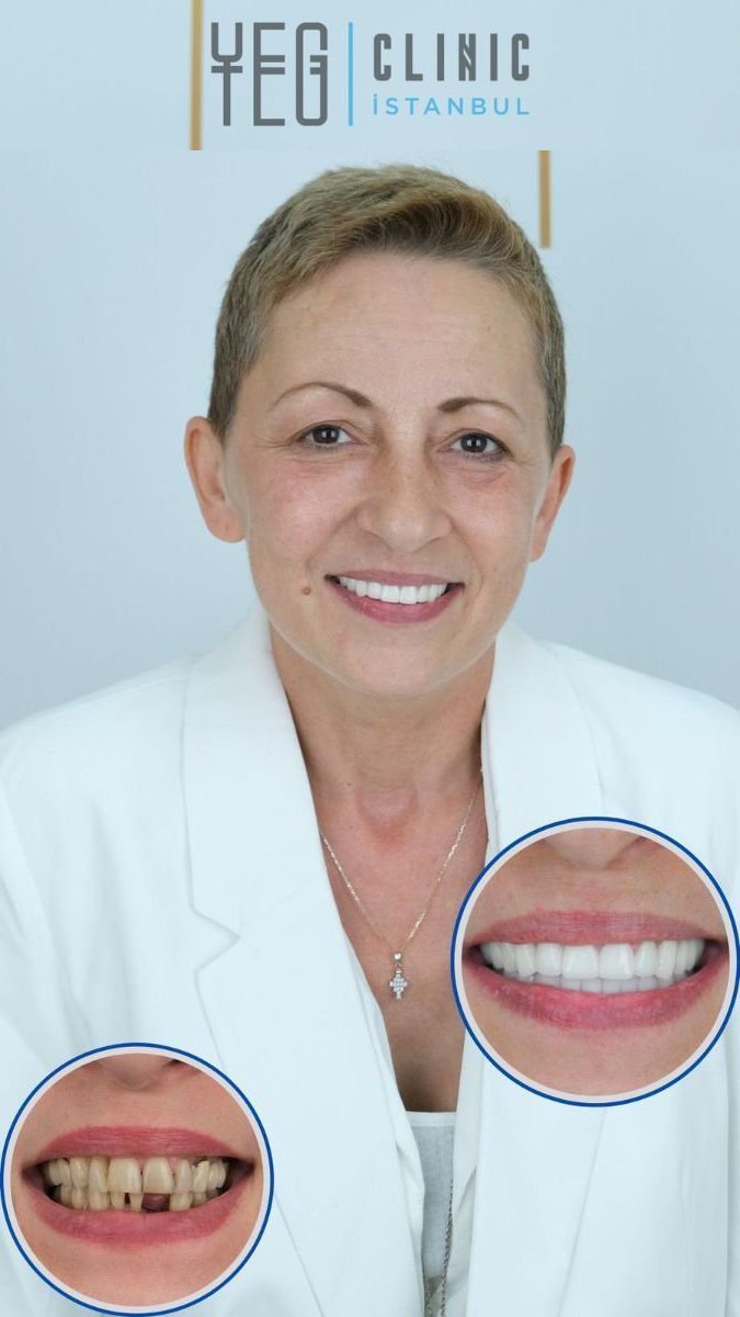 Résultats avant/après prothèse dentaire à YEG Clinic – sourire amélioré et naturel