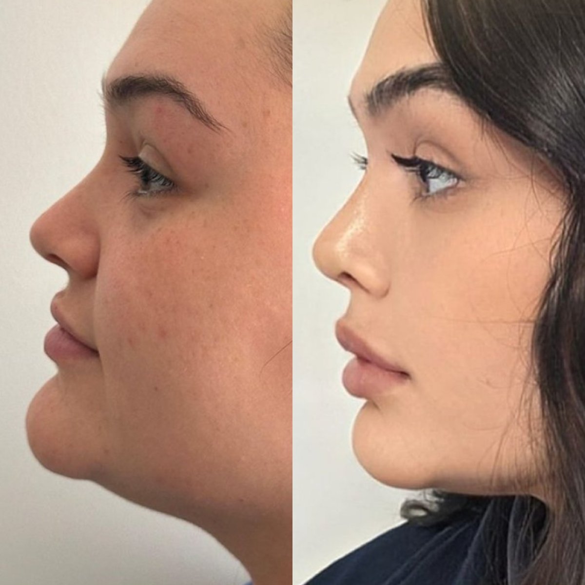 نتائج عملية تجميل الأنف قبل وبعد في عيادة Dr. Safa Manav، تحسين شكل الأنف والملف الجانبي