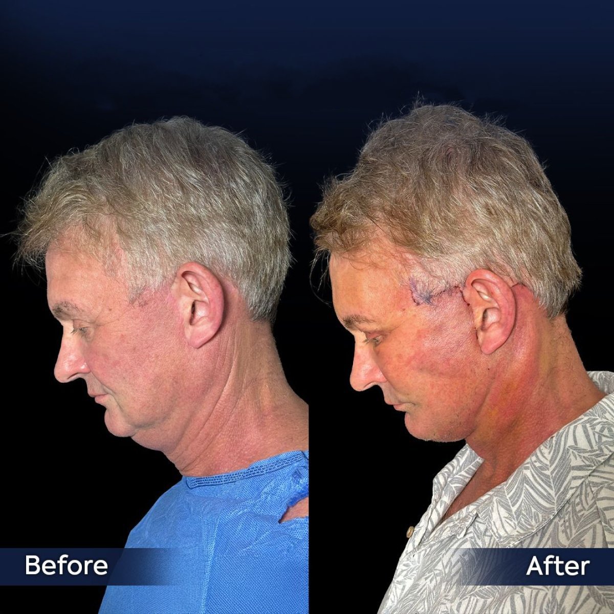 Resultados antes y después de lifting de cuello en Dr. Safa Manav Clinic, contorno visible