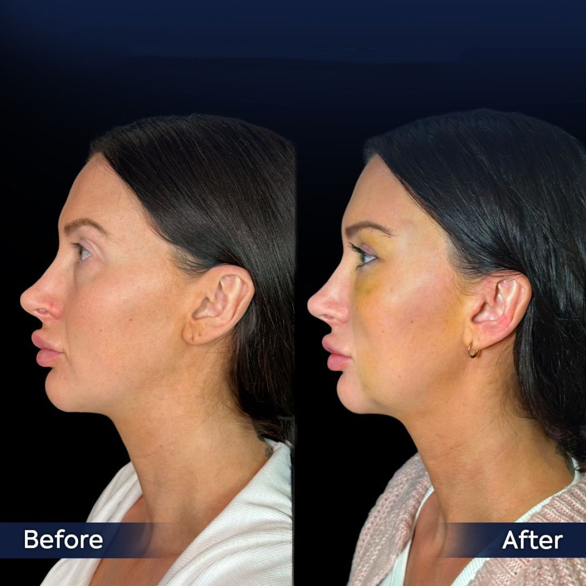 Résultats lifting des sourcils avant/après à la clinique Dr. Safa Manav, front relevé visible