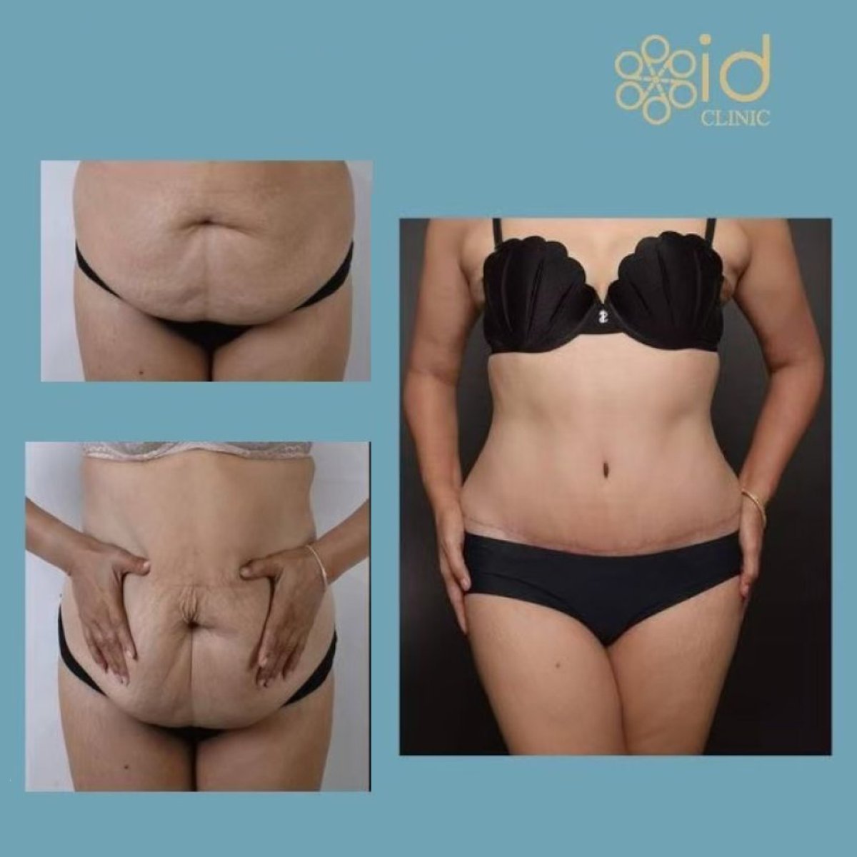 Mommy makeover before and after results at ID Clinic Bangkok – visible abdominal contouring