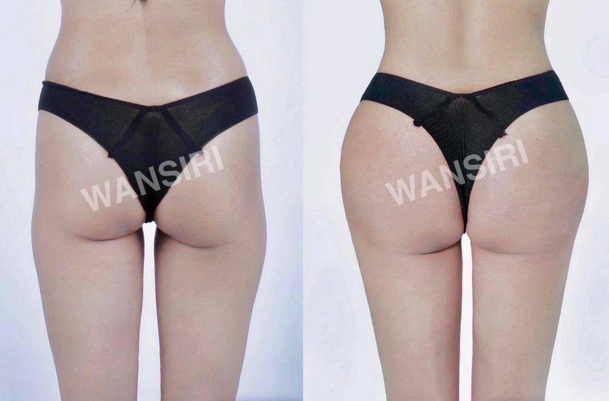 Résultats avant/après Brazilian Butt Lift à Wansiri Hospital, galbe des fesses amélioré