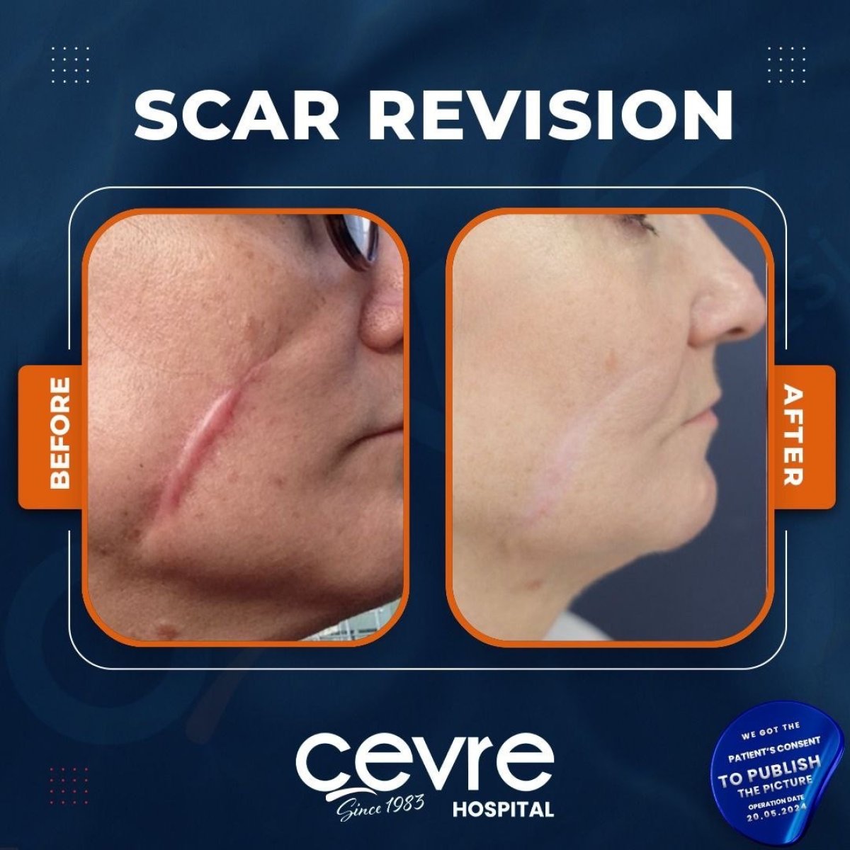 Résultats avant/après révision de cicatrice au Cevre Hospital, aspect facial amélioré