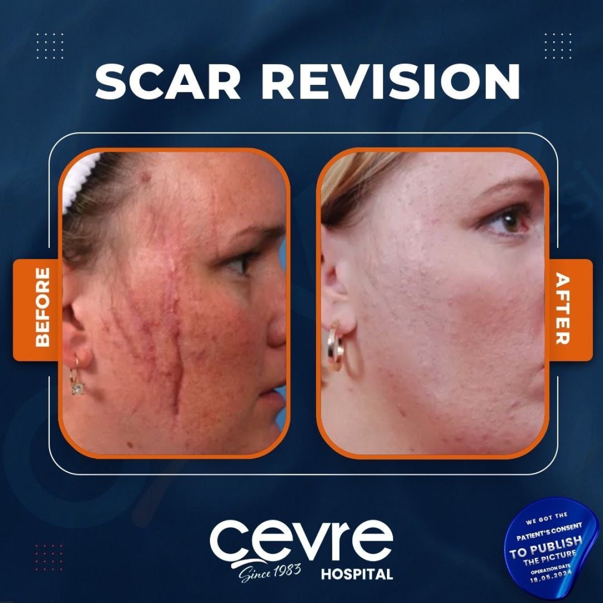 Before and after scar revision results at Adem and Havva Medical Center, improved facial skin
