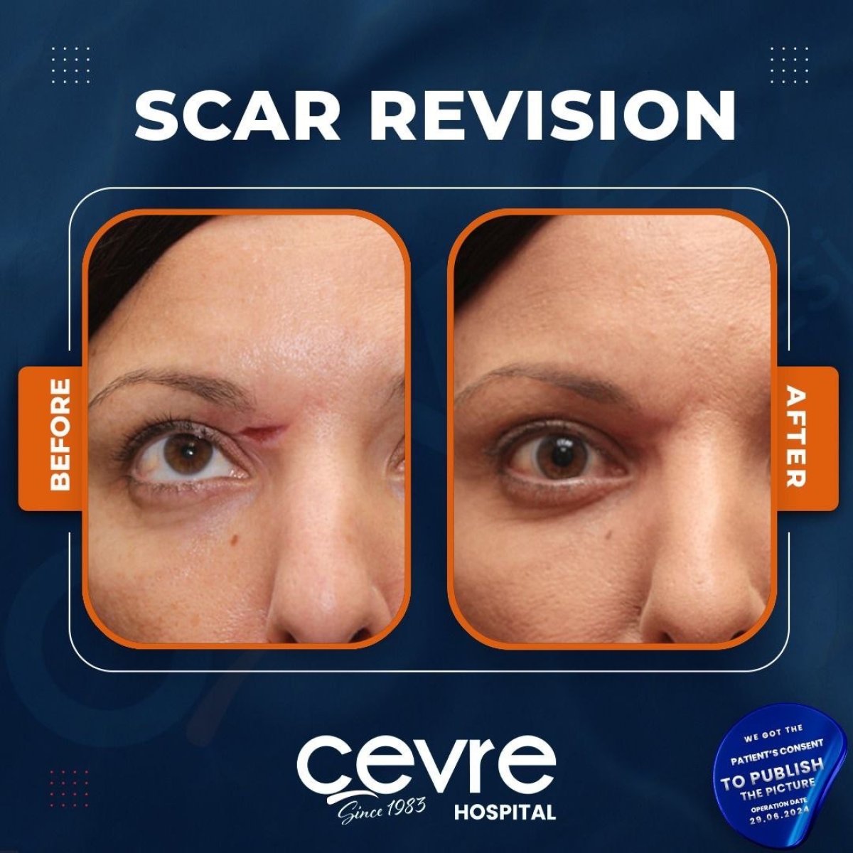Scar revision before and after results at Adem and Havva Medical Center, improved forehead scar