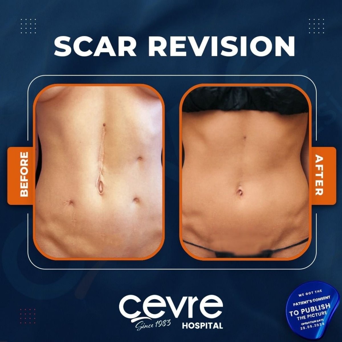 Before and after scar revision results at Adem and Havva Medical Center, smoother abdomen skin