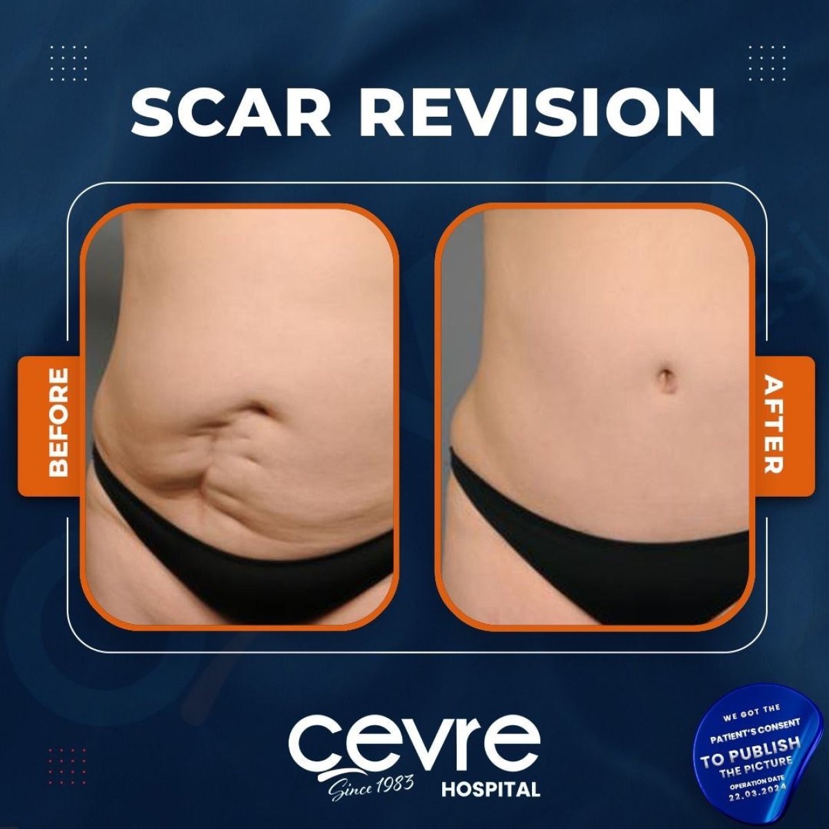 Before and after scar revision results at Adem and Havva Medical Center, smoother abdomen skin
