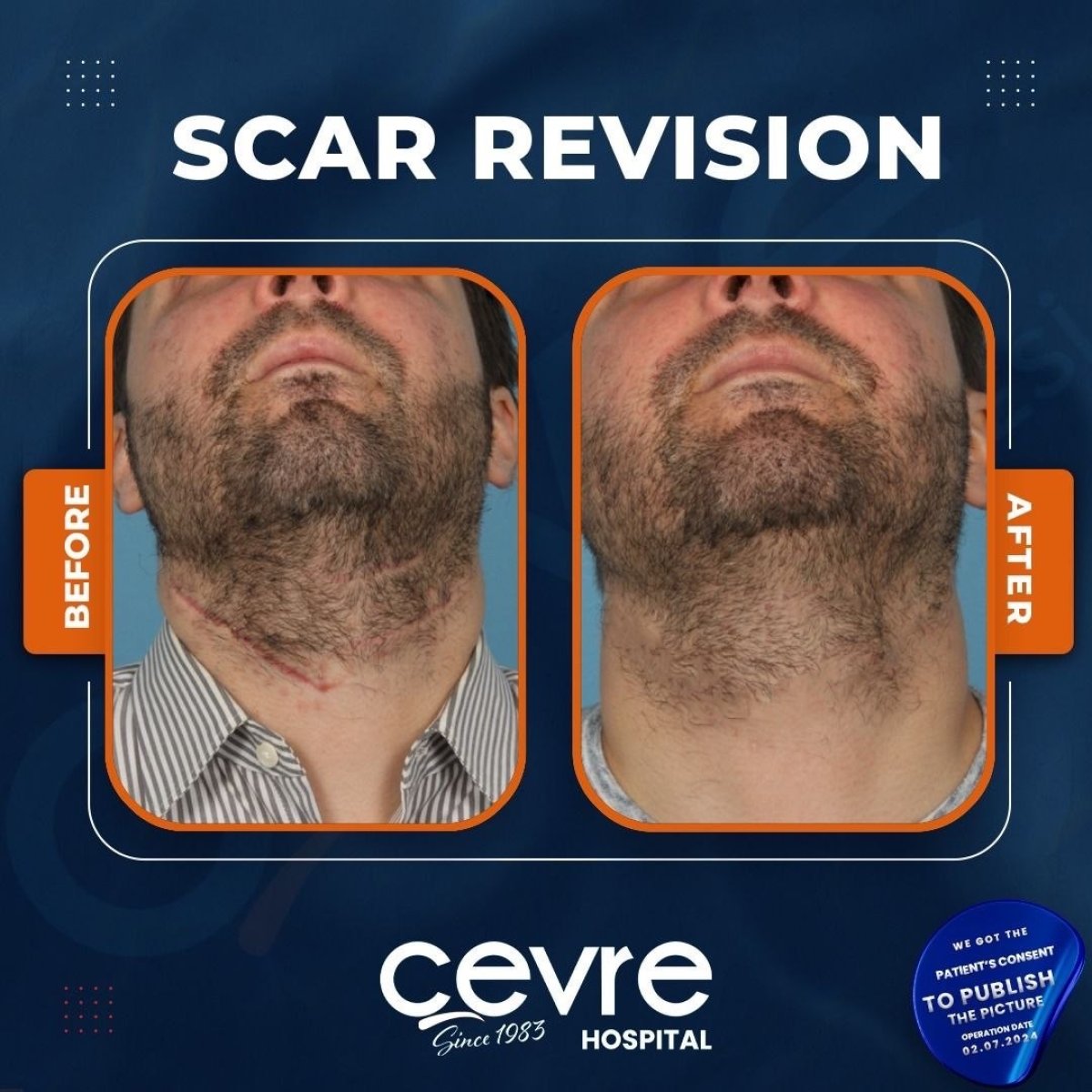 Resultados antes y después de la revisión de cicatriz en cuello en Adem and Havva Medical Center