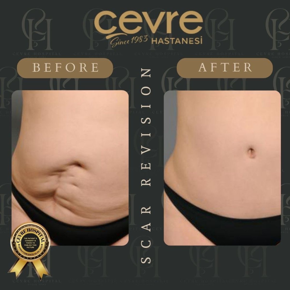 Resultados de revisión de cicatrices antes y después en Adem and Havva Medical Center, abdomen liso