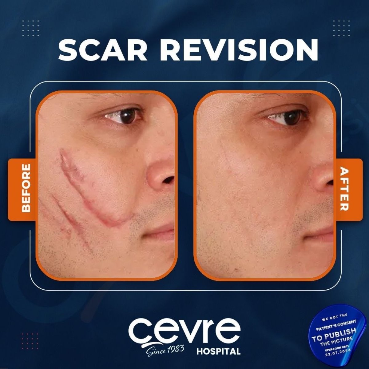 Résultats avant et après révision de cicatrice à Adem and Havva Medical Center, peau du visage améliorée