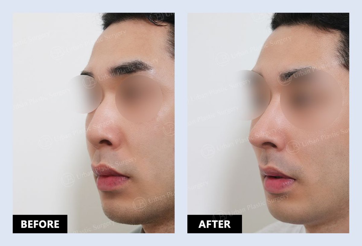 Before and after septoplasty results at URBAN Plastic Surgery for deviated septum correction