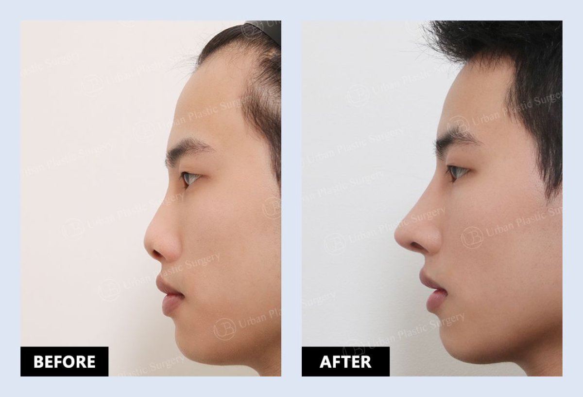 نتائج قبل وبعد عملية تصحيح انحراف الحاجز الأنفي في URBAN Plastic Surgery