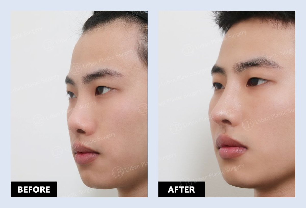 Before and after septoplasty results at URBAN Plastic Surgery for deviated septum correction