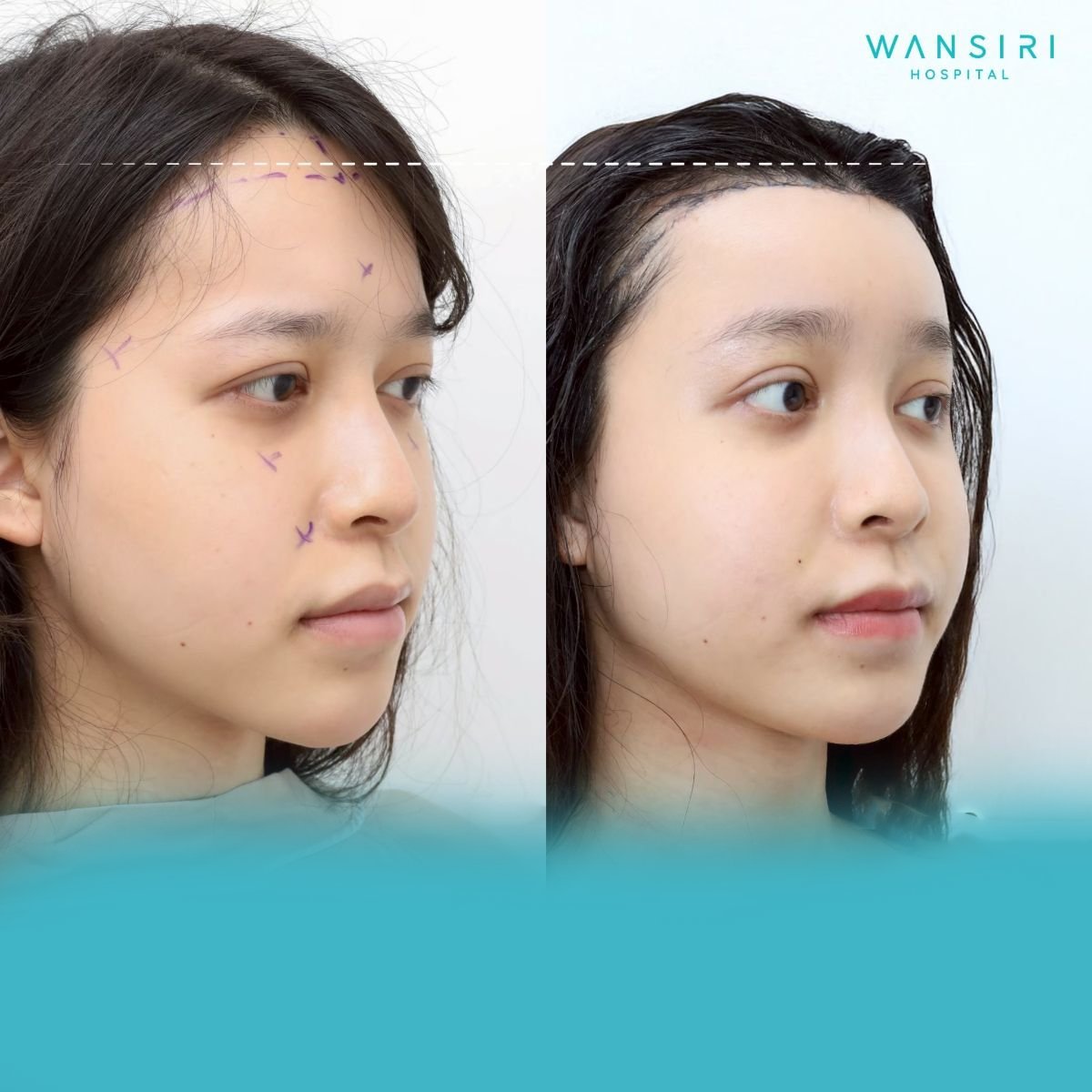 Before and after forehead contouring results at Wansiri Hospital, smoother forehead shape