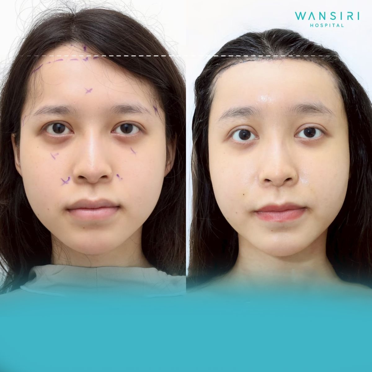 Результаты до и после контурирования лба в Wansiri Hospital, улучшенная форма лба