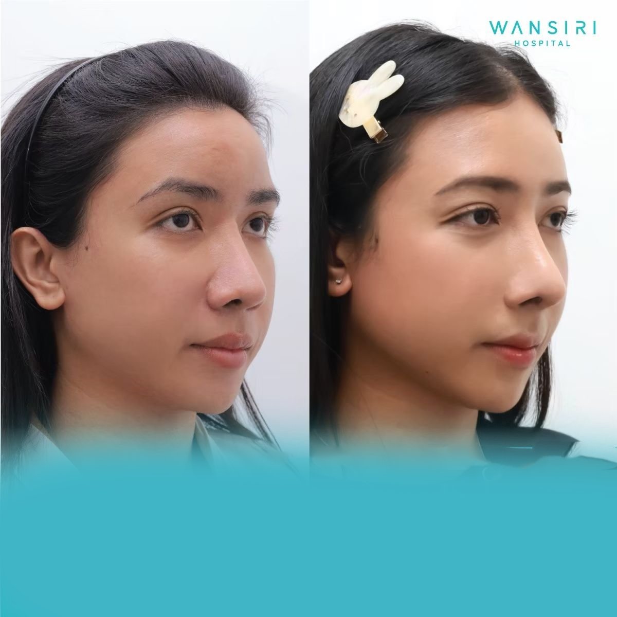Before and after forehead contouring results at Wansiri Hospital, smoother forehead profile