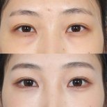 Fotos vor und nach Blepharoplastik (Augenlidkorrektur) durch Dr. Haewon Yang 
