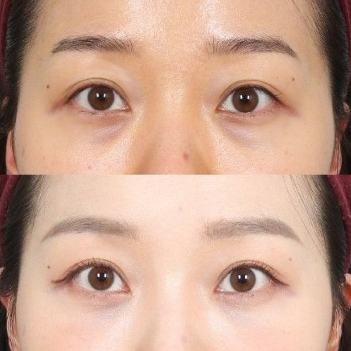 Resultados de blefaroplastia antes y después, corrección de párpados para mirada fresca