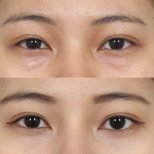 Fotos vor und nach Blepharoplastik (Augenlidkorrektur) durch Dr. Haewon Yang 