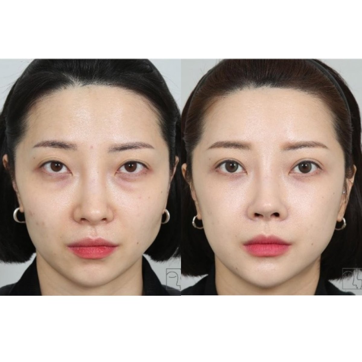 Before and after blepharoplasty results, eyelid correction with rejuvenated eye appearance