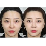 Fotos vor und nach Blepharoplastik (Augenlidkorrektur) durch Dr. Haewon Yang 