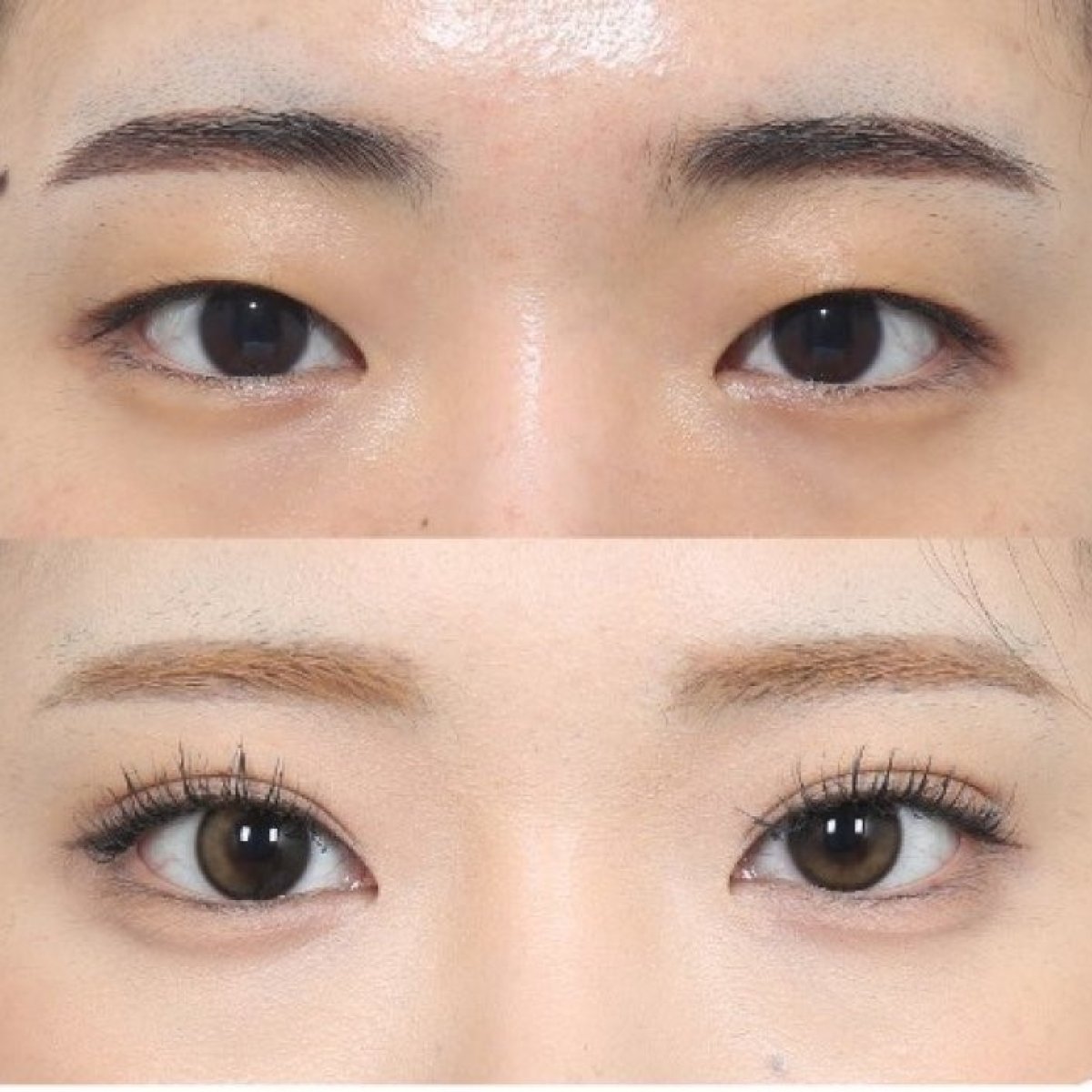 Resultados de blefaroplastia antes y después, corrección de párpados con efecto natural