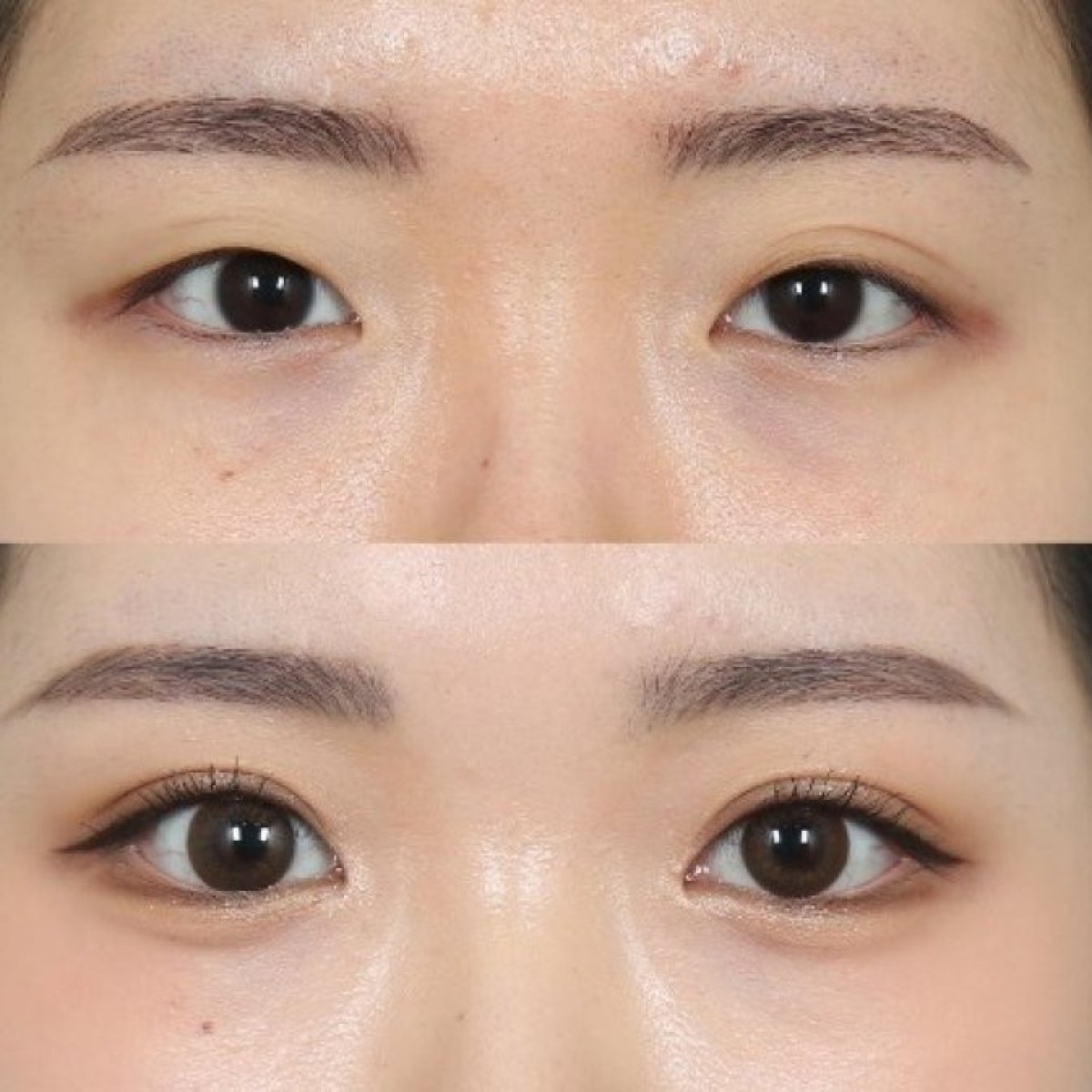 Resultados de blefaroplastia antes y después – corrección natural de párpados