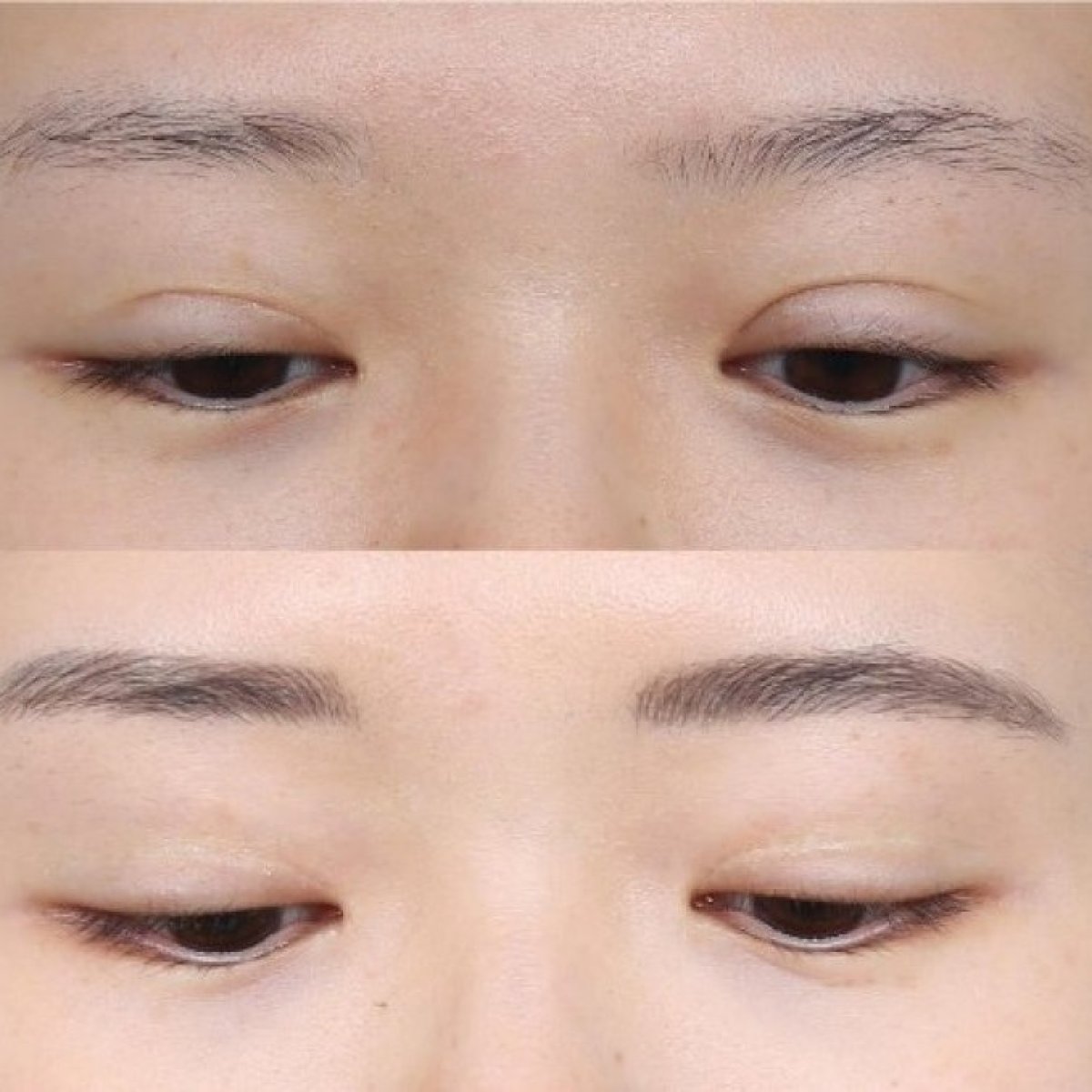 Efekty blefaroplastyki przed i po – naturalna korekta powiek