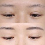 Fotos vor und nach Blepharoplastik (Augenlidkorrektur) durch Dr. Haewon Yang 