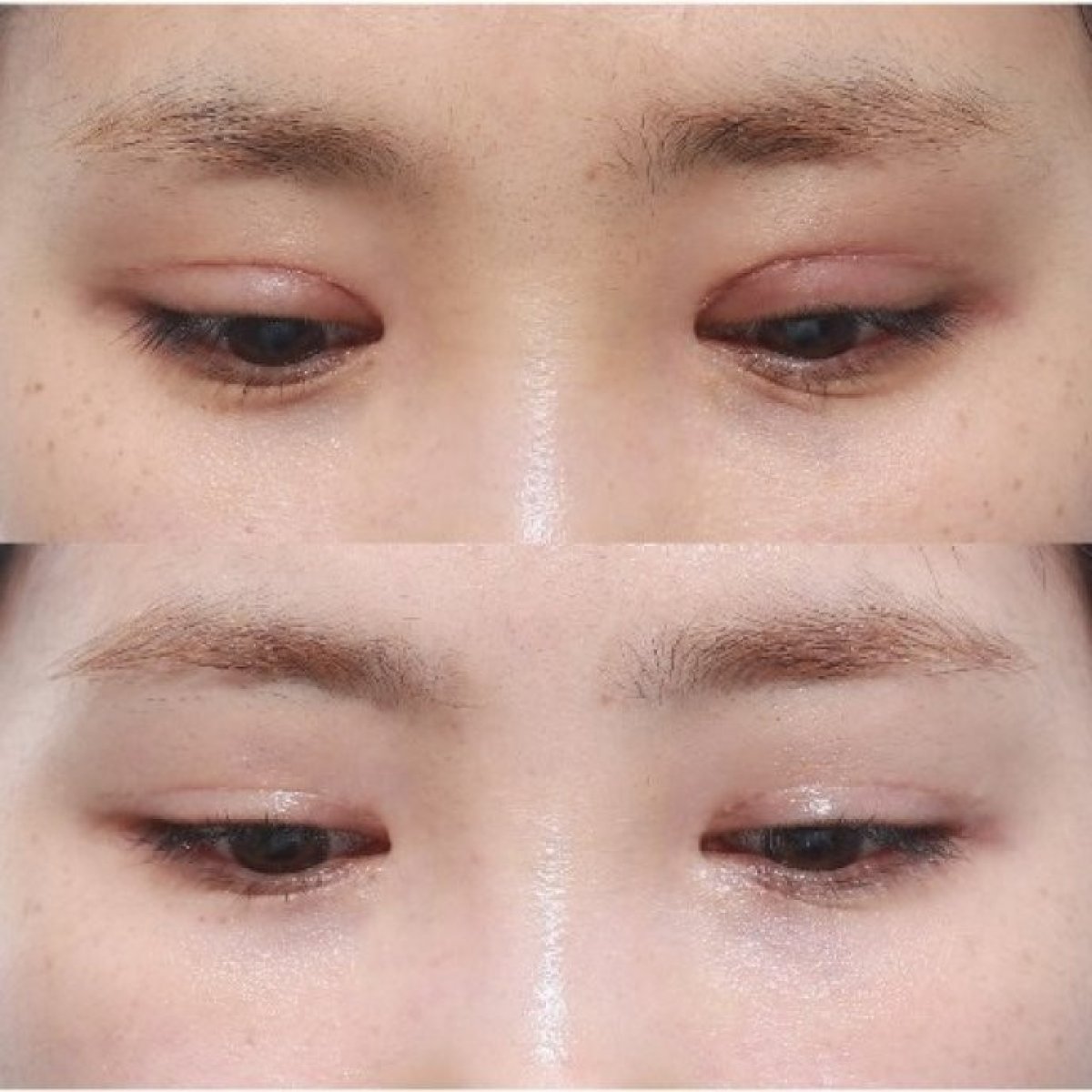 Resultados de blefaroplastia antes y después, corrección de párpados con aspecto natural