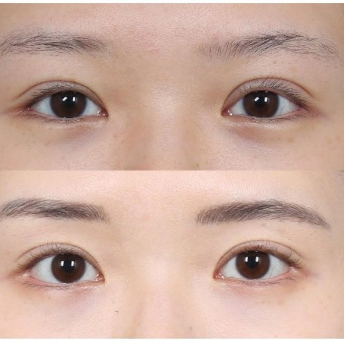 Vorher-nachher-Ergebnis Blepharoplastik, natürliche Lidkorrektur