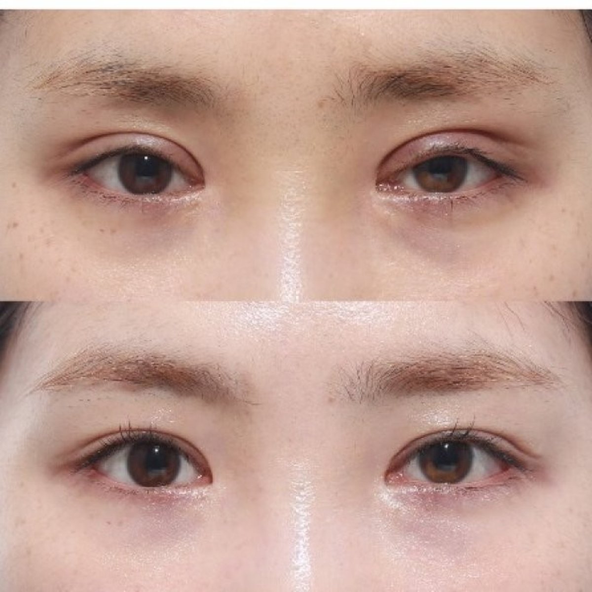 Blepharoplastik Vorher-Nachher-Ergebnis – natürliche Lidkorrektur