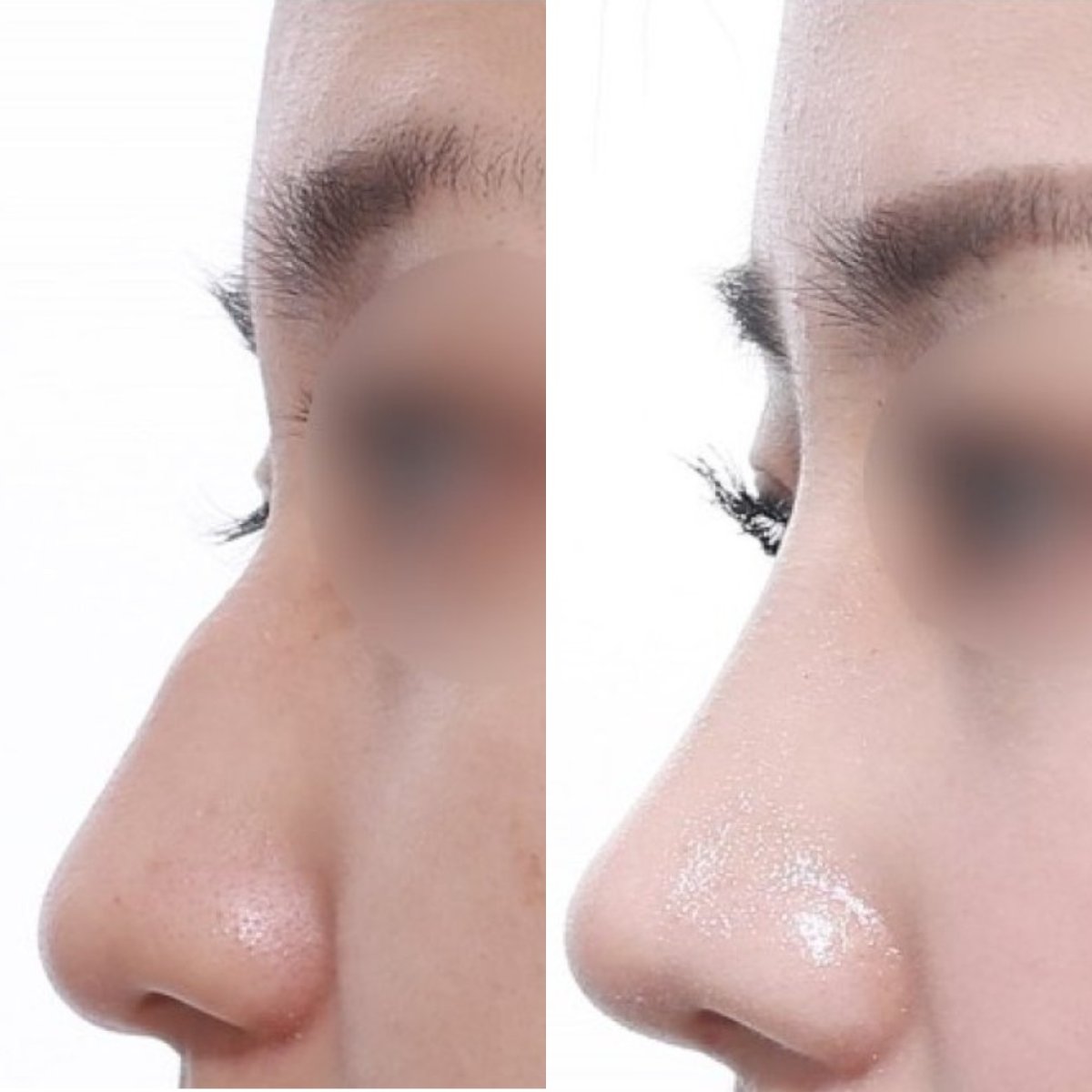 نتائج عملية تجميل الأنف قبل وبعد، تحسين شكل الأنف وتحديده بعد الجراحة