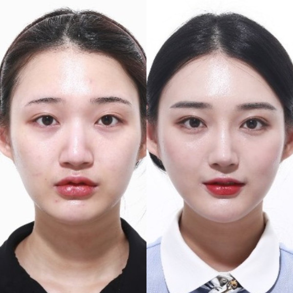 Resultados de rinoplastia antes y después, mejora visible de nariz y rostro