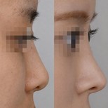 Ergebnisse der Rhinoplastik (Nasenkorrektur) durch Dr. Haewon Yang — Vorher- und Nachher-Fotos des Patienten Fotos vor und nach Rhinoplastik (Nasenkorrektur) durch Dr. Haewon Yang