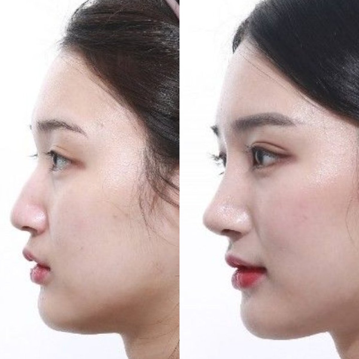 نتائج تجميل الأنف قبل وبعد، إعادة تشكيل الأنف وتحسين المظهر الجانبي الطبيعي
