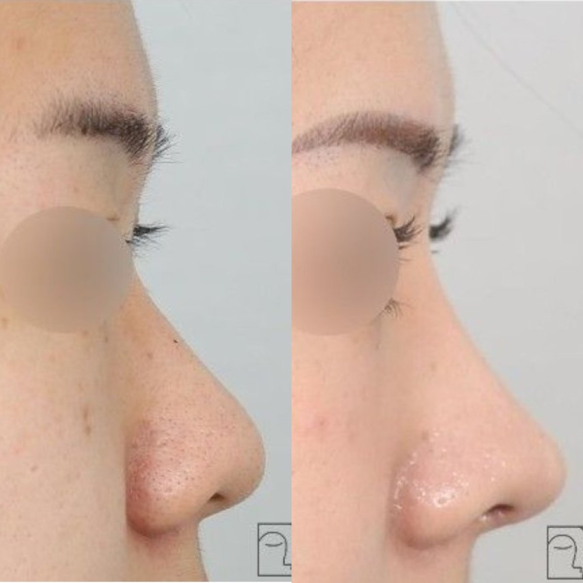 Resultados de rinoplastia antes y después, perfil y contorno nasal mejorados