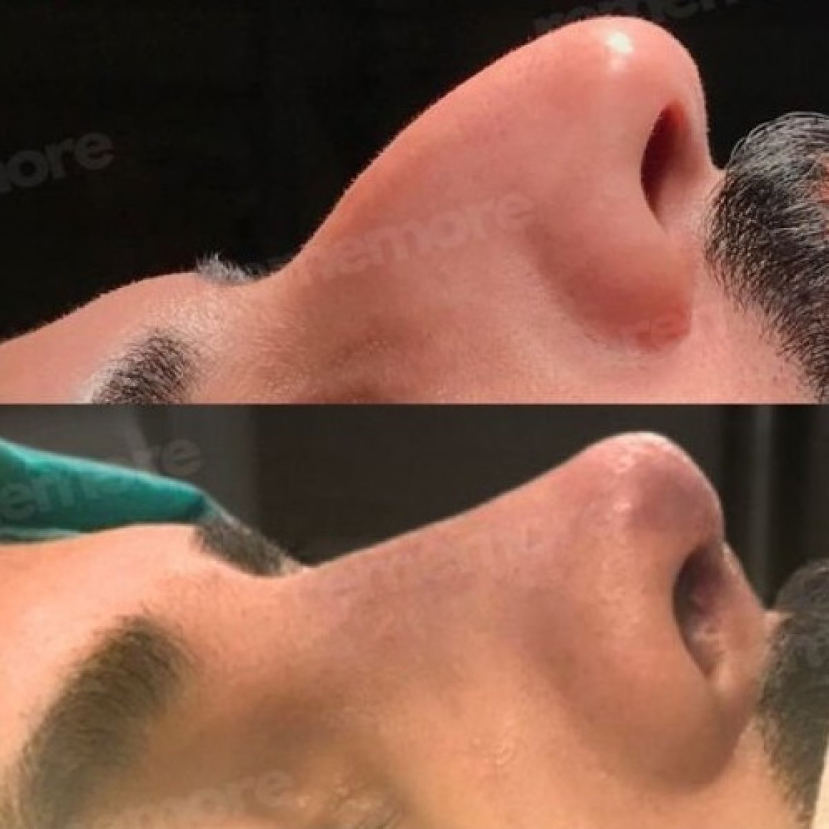 Before and after male rhinoplasty results at Memorial Şişli Hospital, improved nose profile