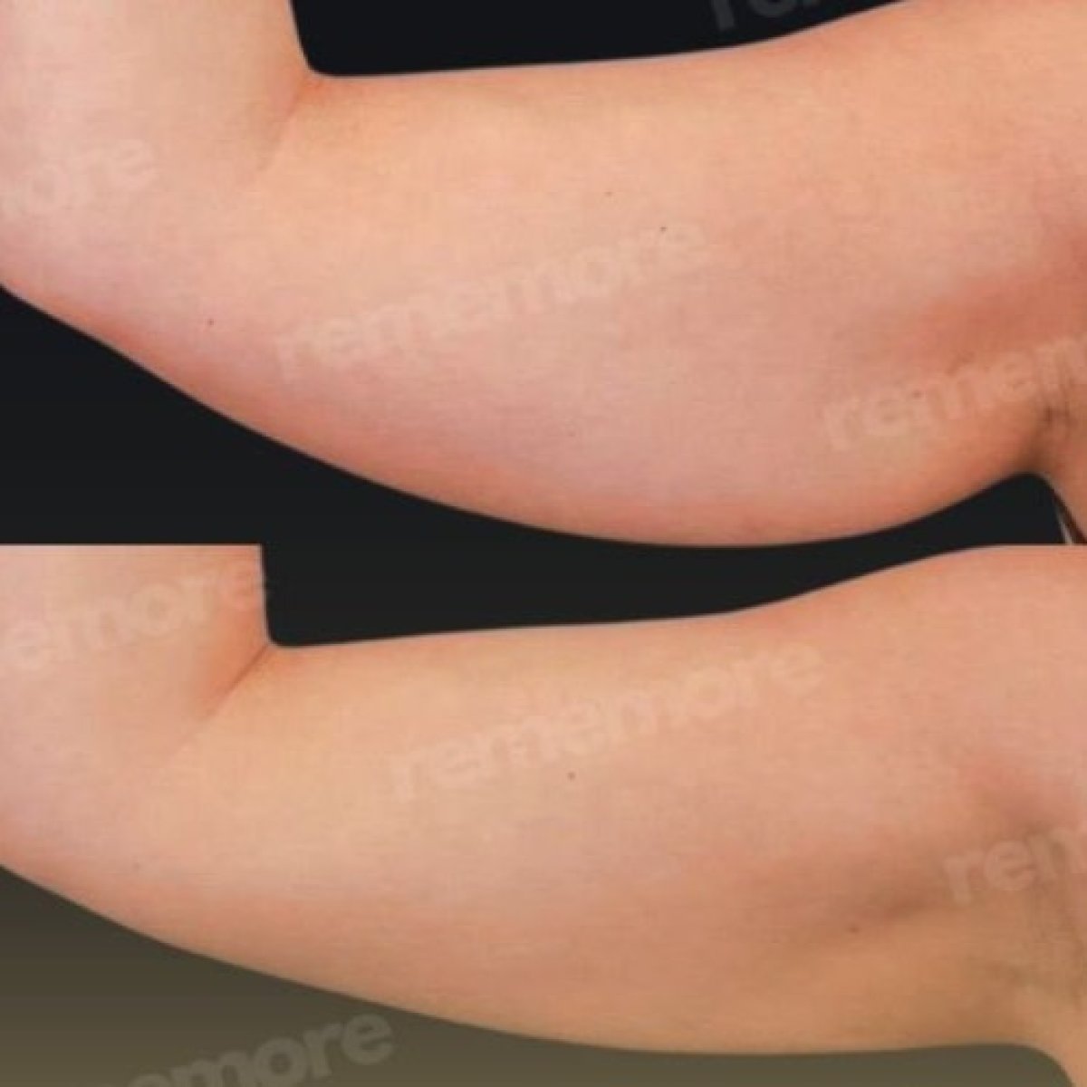 Before and after arm lift results at Memorial Şişli Hospital, improved arm contour visible