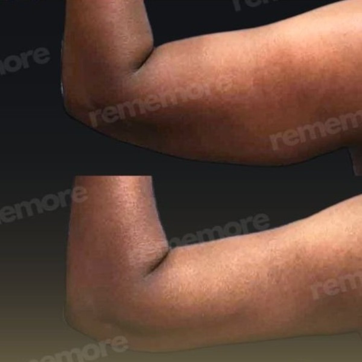 Before and after arm lift (brachioplasty) results at Memorial Şişli Hospital, improved contour