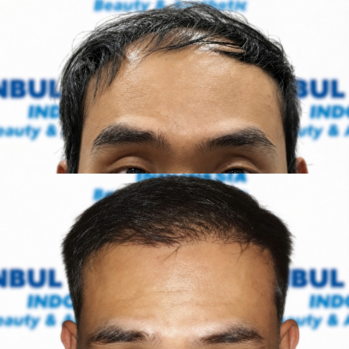 Résultats avant/après greffe de cheveux organique chez Istanbul Hair Indonesia, ligne améliorée