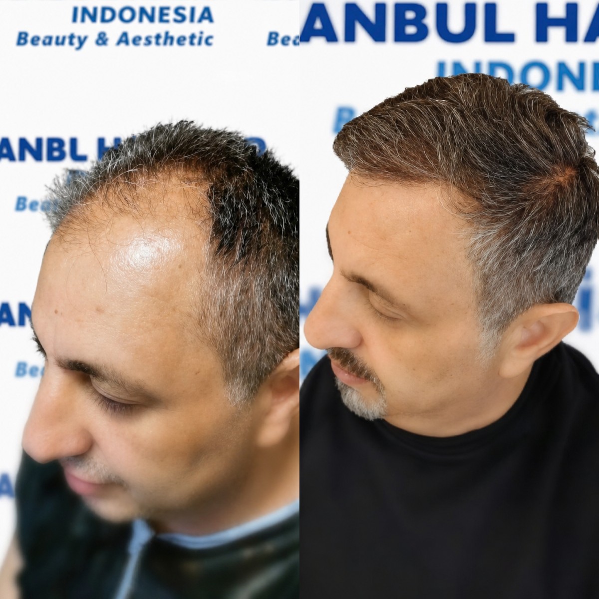 Resultados antes y después de trasplante capilar orgánico en Istanbul Hair Indonesia, línea restaurada