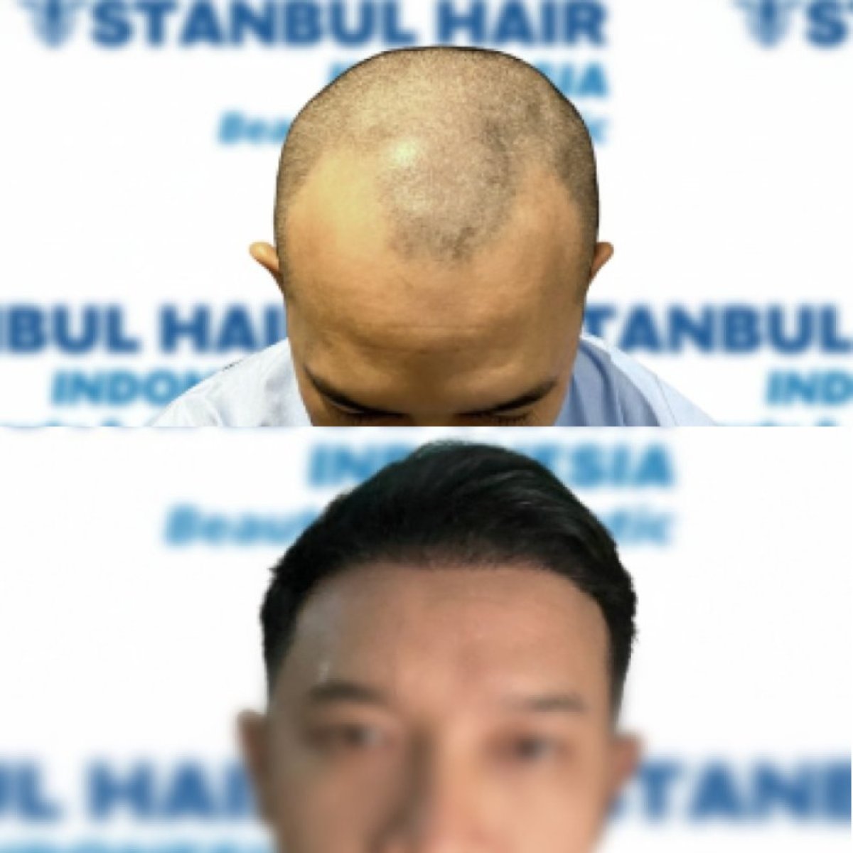 Результаты пересадки волос Sapphire FUE до и после в клинике Istanbul Hair Indonesia