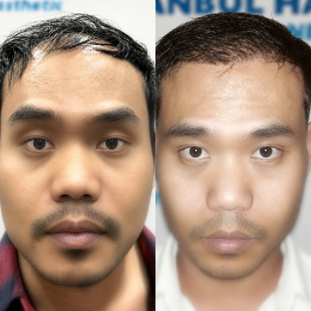 Resultados antes y después de trasplante capilar orgánico en Istanbul Hair Indonesia, línea mejorada