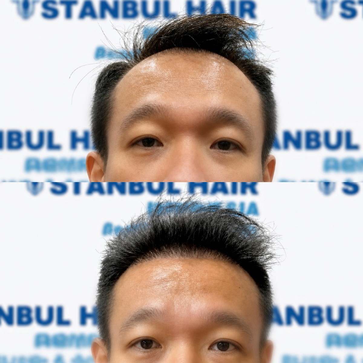 Результат пересадки волос Sapphire FUE до и после в Istanbul Hair Indonesia, густая линия роста